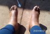Swollen feet