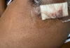 Wound 2