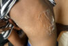 Wound 1